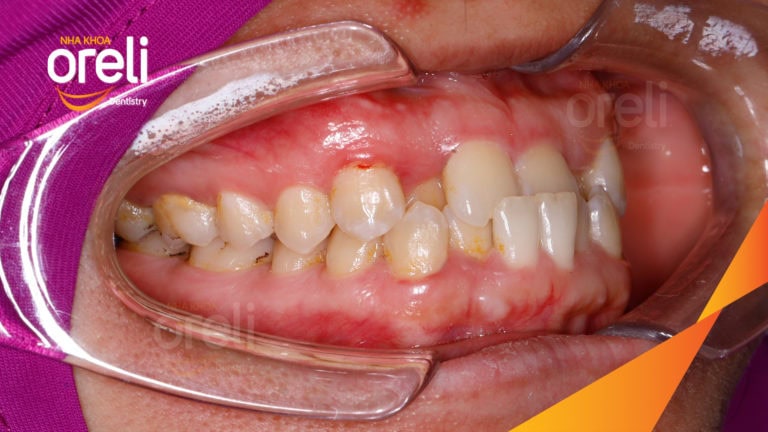 Ca niềng chỉnh sai khớp cắn hạng 3 móm nặng kèm chen chúc kết quả thực tế sau 3 năm