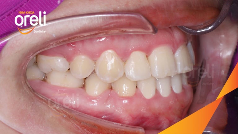 Ca niềng chỉnh sai khớp cắn hạng 3 móm nặng kèm chen chúc kết quả thực tế sau 3 năm