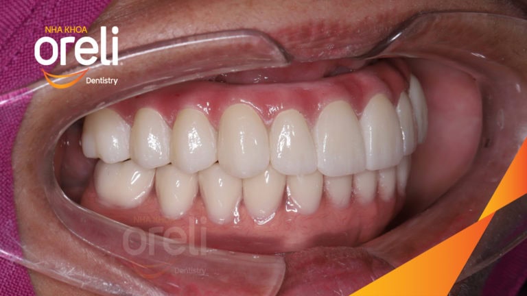 Từ hàm tháo lắp sang Implant All-on-6 – Kết quả khác biệt tại Oreli