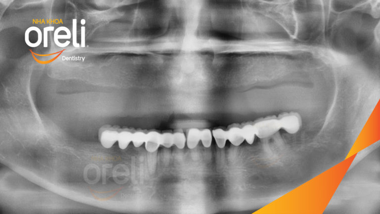 Từ hàm tháo lắp sang Implant All-on-6 – Kết quả khác biệt tại Oreli