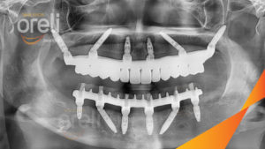Implant chân bướm(Pterygoid)