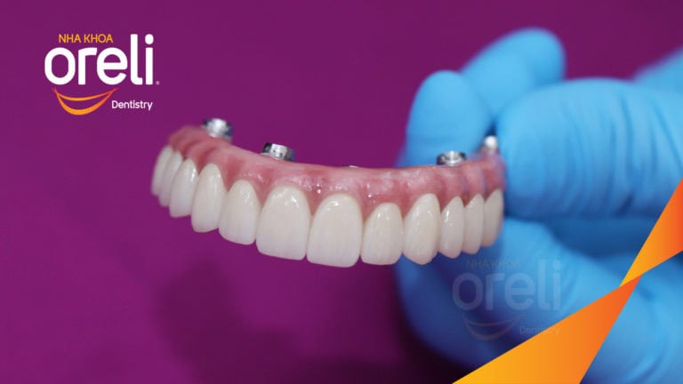 Từ hàm tháo lắp sang Implant All-on-6 – Kết quả khác biệt tại Oreli