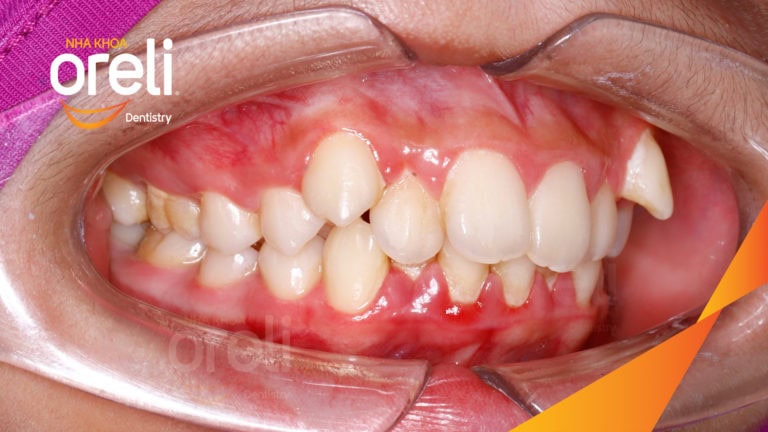 Ca niềng chỉnh chen chúc và cắn sâu nặng kết quả sau 2 năm tại nha khoa Oreli