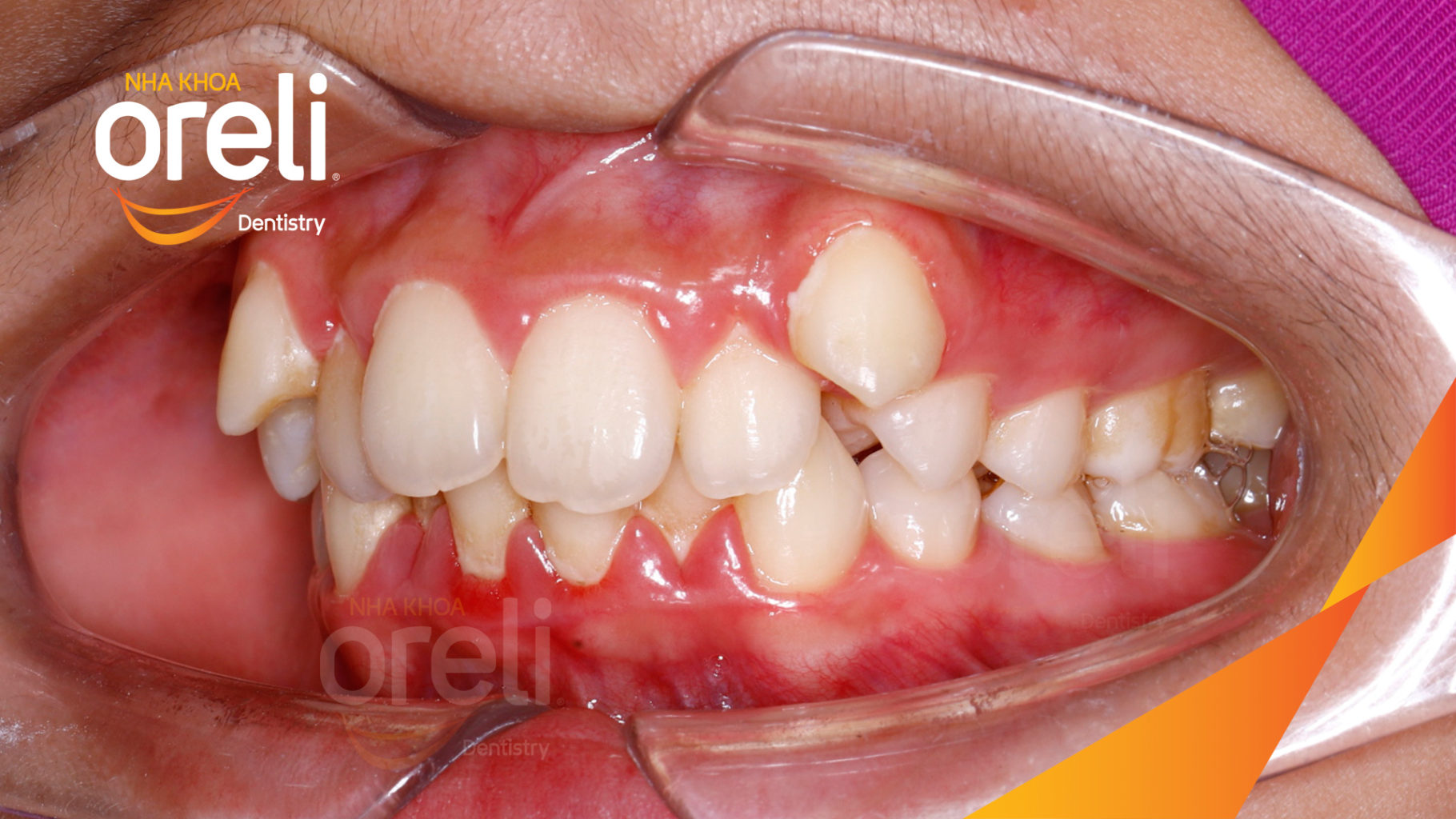 Trước điều trị:  tại Oreli