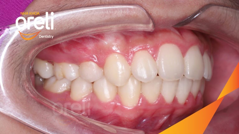 Ca niềng chỉnh chen chúc và cắn sâu nặng kết quả sau 2 năm tại nha khoa Oreli