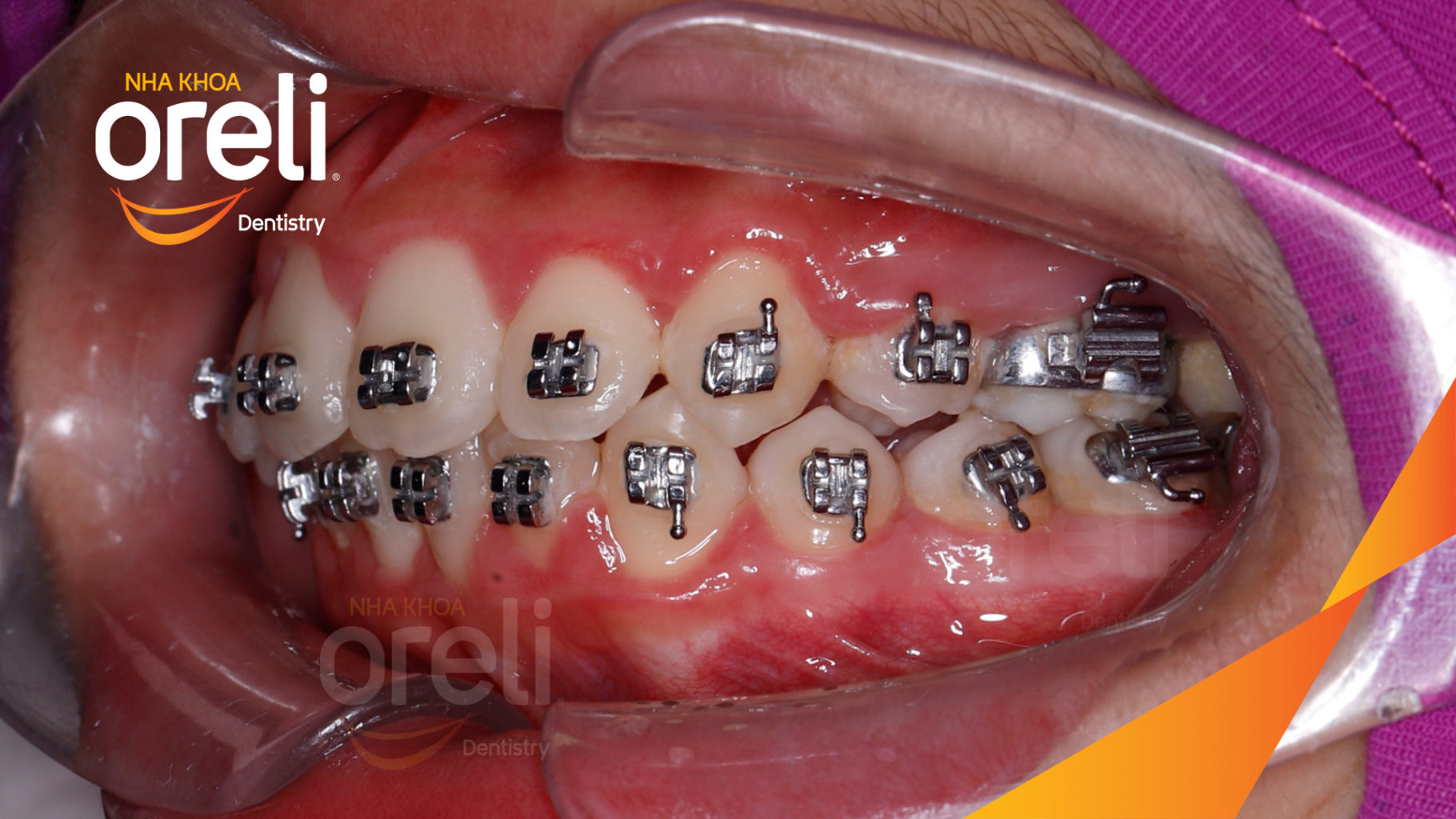  trước khi điều trị tại Oreli