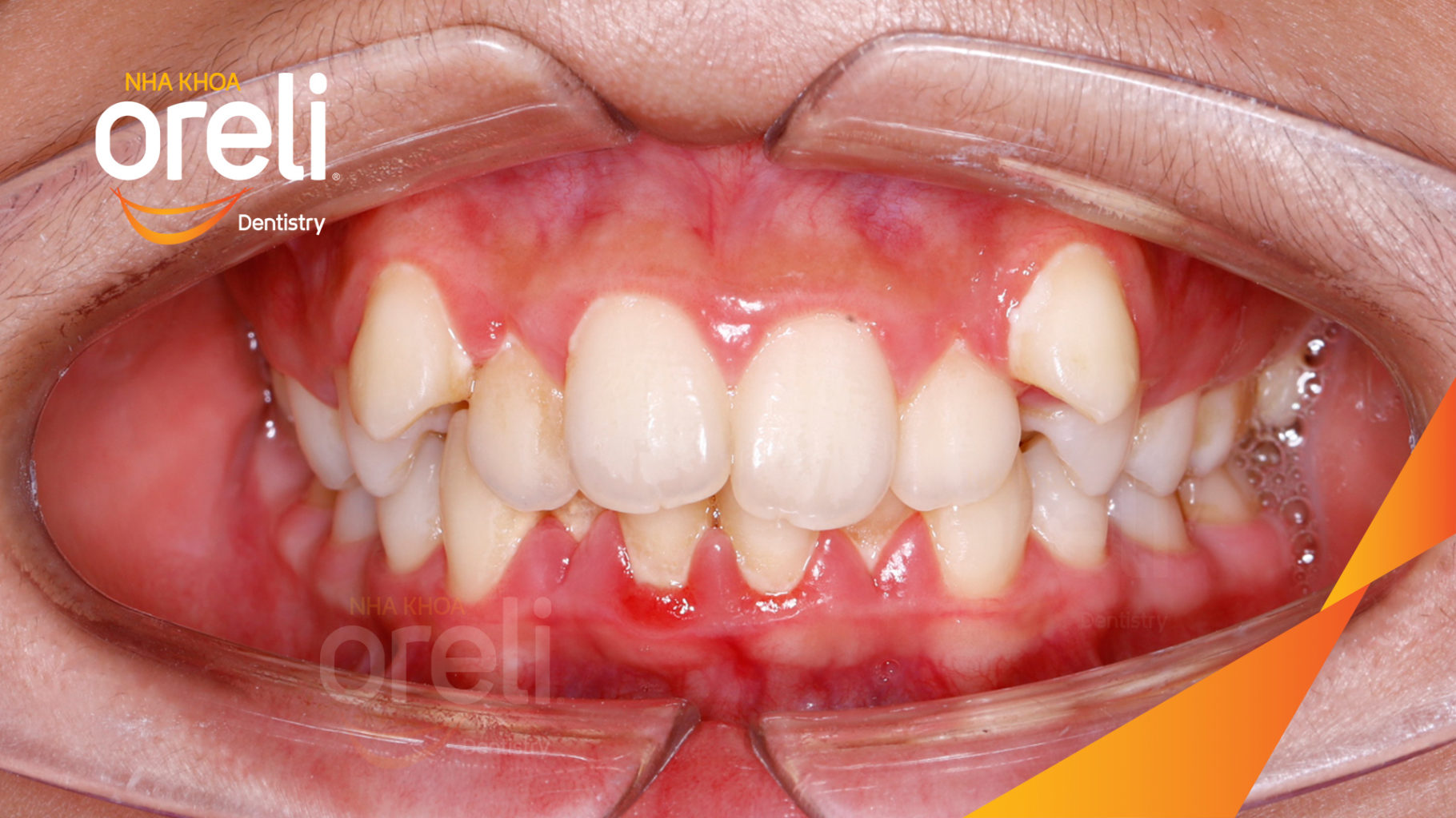 Thực hiện  kéo dài  tại Oreli