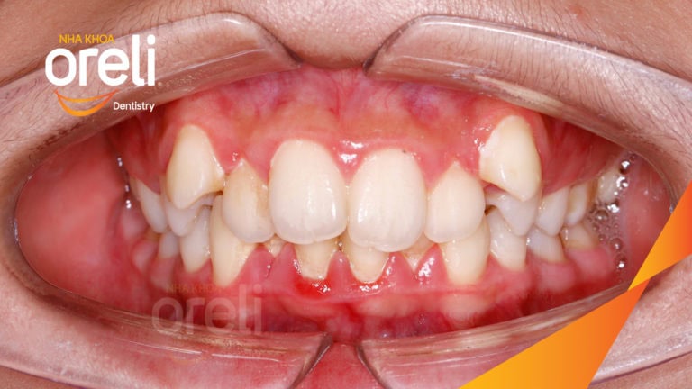 Ca niềng chỉnh chen chúc và cắn sâu nặng kết quả sau 2 năm tại nha khoa Oreli