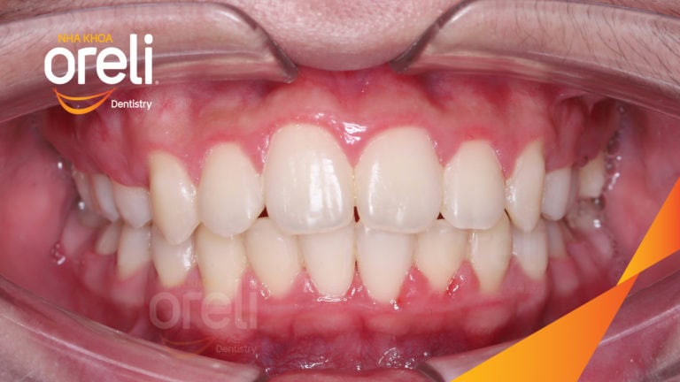Ca niềng chỉnh chen chúc và cắn sâu nặng kết quả sau 2 năm tại nha khoa Oreli
