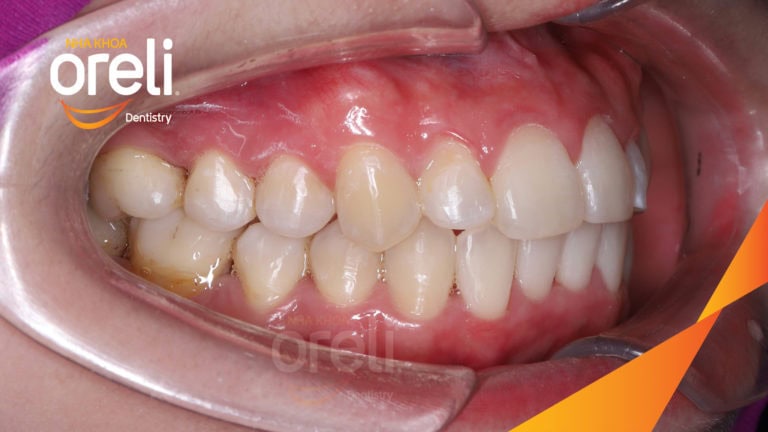 Ca niềng chỉnh hô không nhổ răng 4 tại Oreli