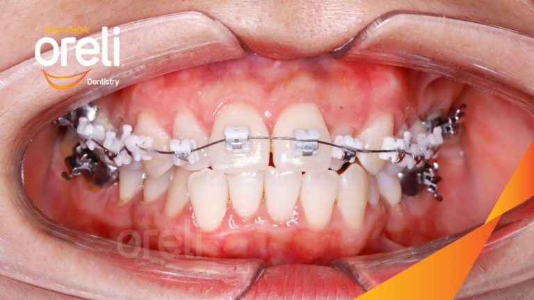 Ca niềng chỉnh hô không nhổ răng 4 tại Oreli
