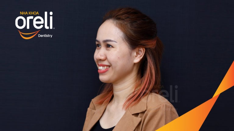 Ca niềng chỉnh hô không nhổ răng 4 tại Oreli