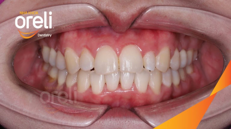 Ca niềng chỉnh hô không nhổ răng 4 tại Oreli