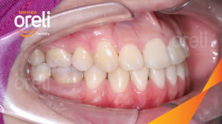 Niềng răng móm không phẫu thuật – Trước & sau tại Nha khoa Oreli