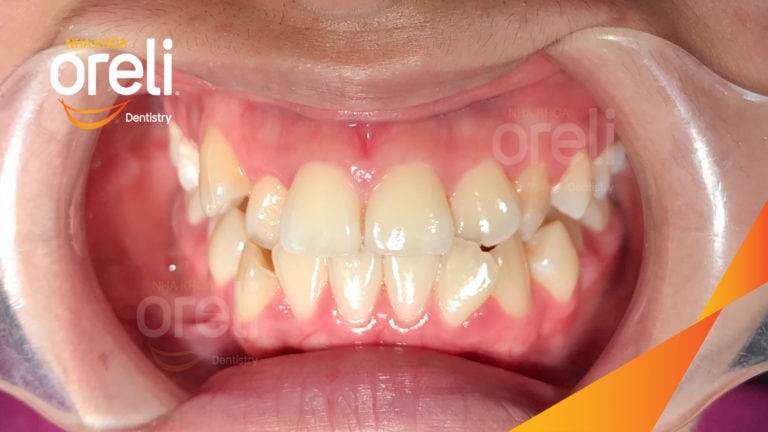 Niềng răng móm không phẫu thuật – Trước & sau tại Nha khoa Oreli