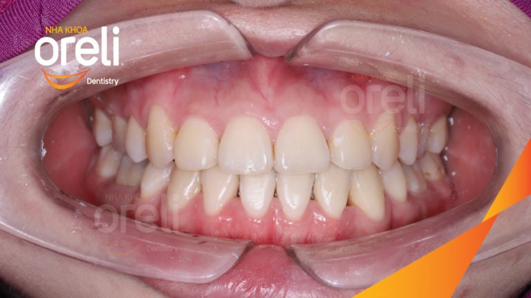 Niềng răng móm không phẫu thuật – Trước & sau tại Nha khoa Oreli
