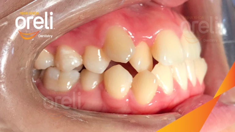 Niềng răng móm không phẫu thuật – Trước & sau tại Nha khoa Oreli