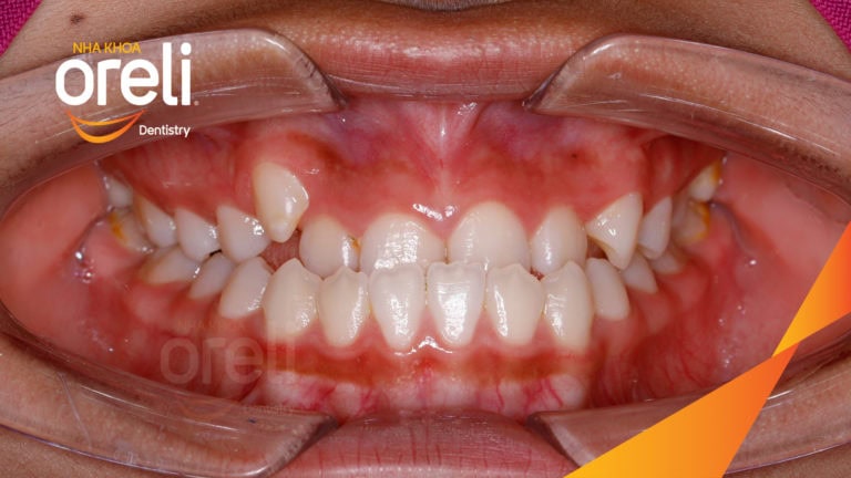Niềng răng móm hạng 3 nặng – Kết quả sau 24 tháng tại Nha khoa Oreli
