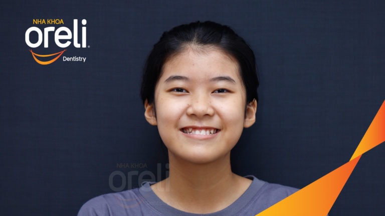 Niềng răng móm hạng 3 nặng – Kết quả sau 24 tháng tại Nha khoa Oreli