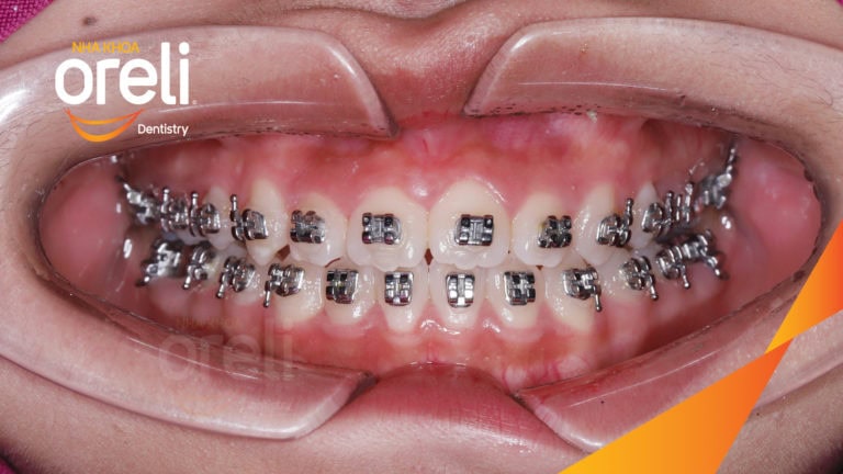 Niềng răng móm hạng 3 nặng – Kết quả sau 24 tháng tại Nha khoa Oreli