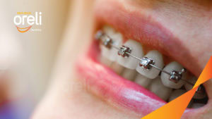 Niềng răng mắc cài kim loại