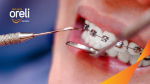 Niềng răng mắc cài tự khóa