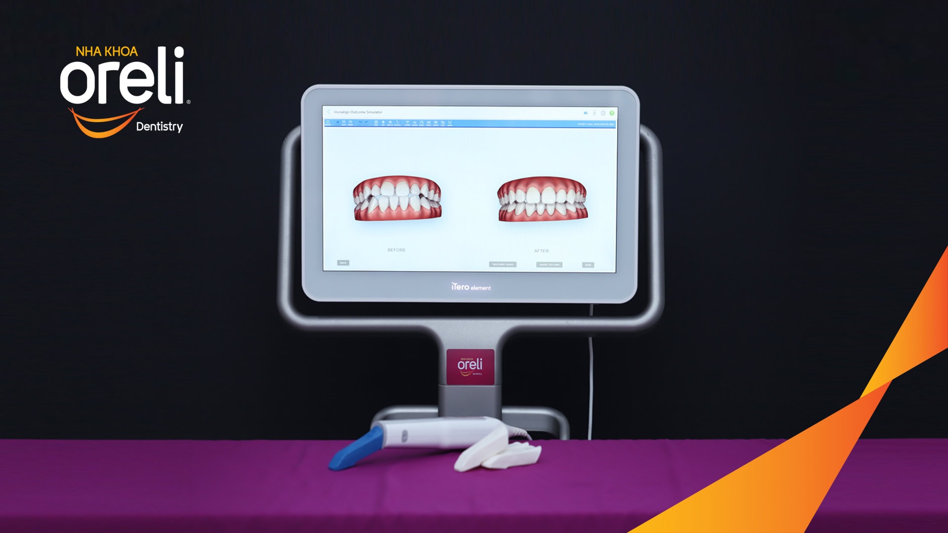 nieng rang invisalign
