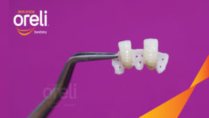 Phục hình cánh dán không mài răng