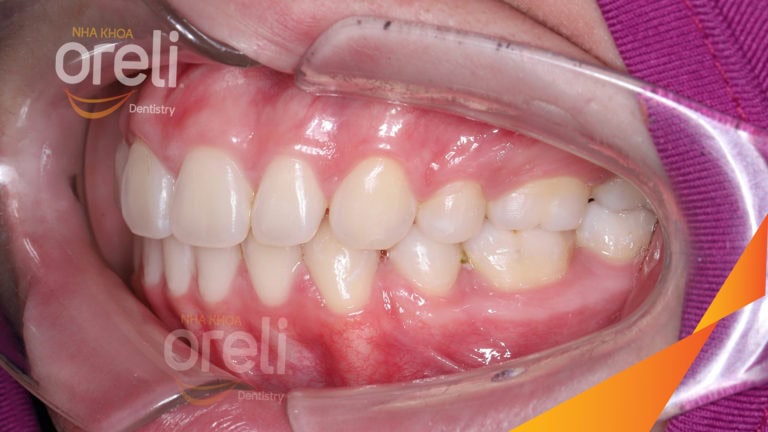 Ca chỉnh hô có nhổ 4 răng 4 thay đổi góc nghiêng đẹp – Kết quả thay đổi sau 3 năm tại nha khoa Oreli