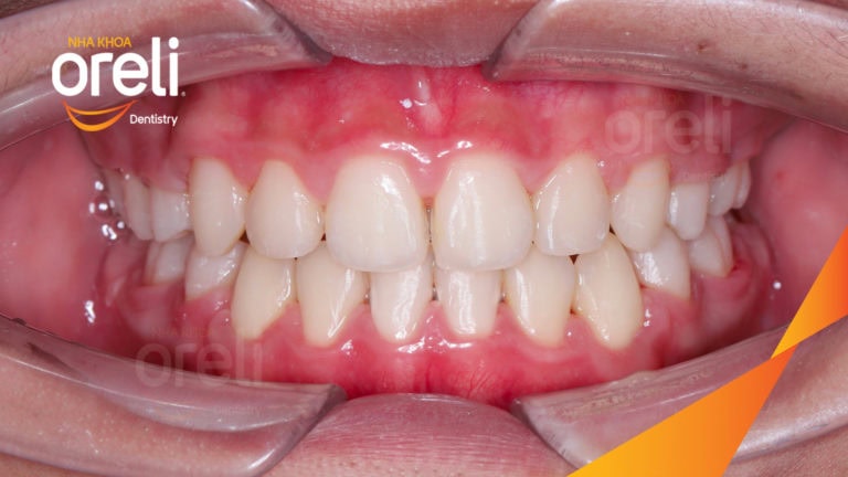 Ca chỉnh cắn sâu chen chúc hai hàm nặng