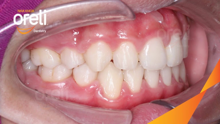 Ca chỉnh cắn sâu chen chúc hai hàm nặng