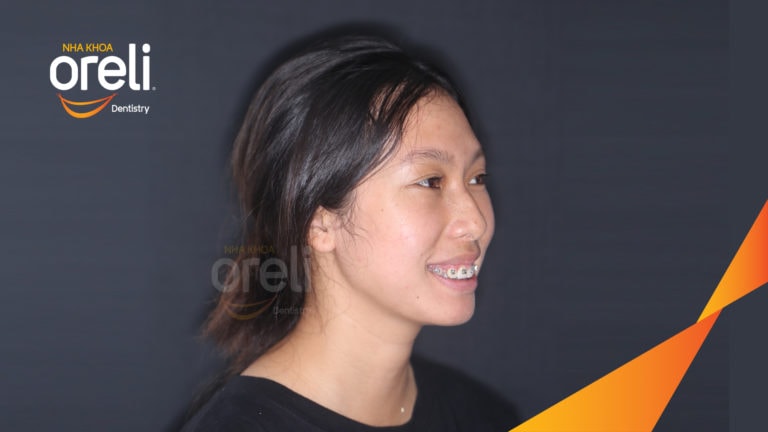 nieng rang chinh ho can sau uy tin nha khoa oreli