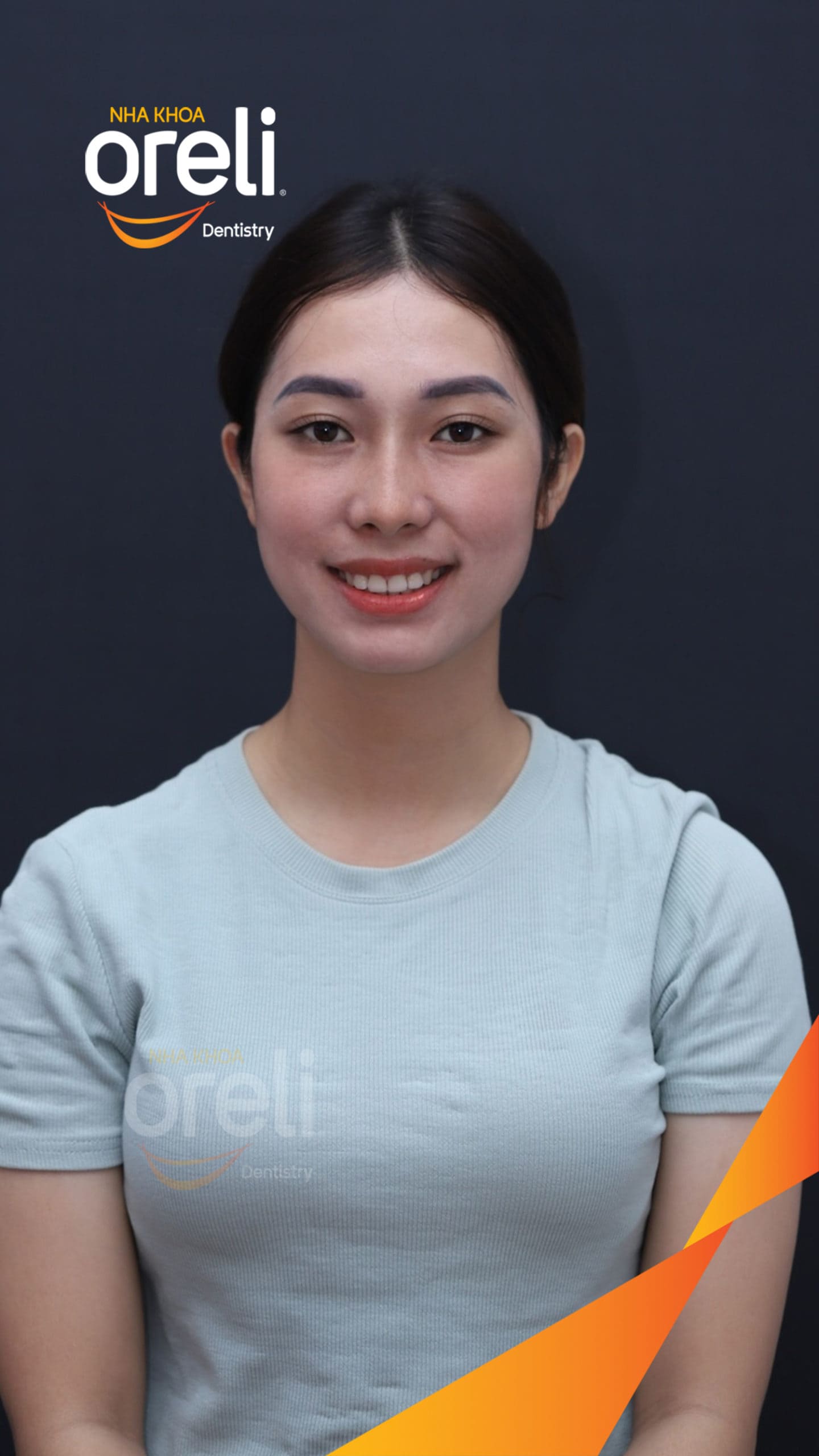 nieng rang chinh ho can sau uy tin nha khoa oreli