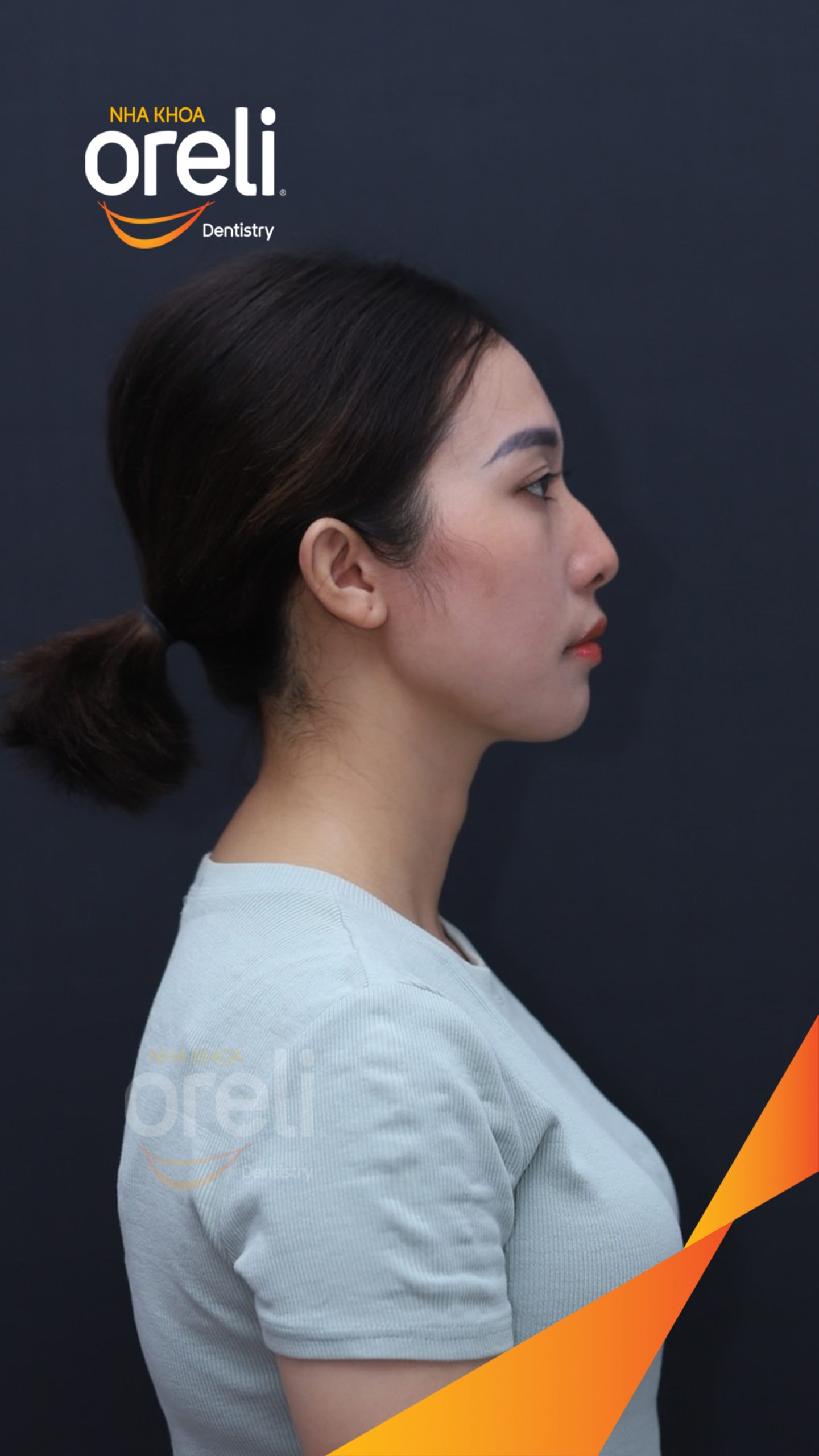 nieng rang chinh ho can sau uy tin nha khoa oreli
