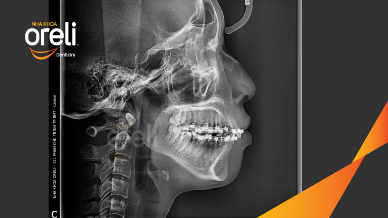 Ca niềng lại chỉnh cắn sâu hô hai hàm