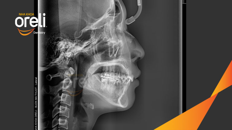 Ca niềng lại chỉnh cắn sâu hô hai hàm