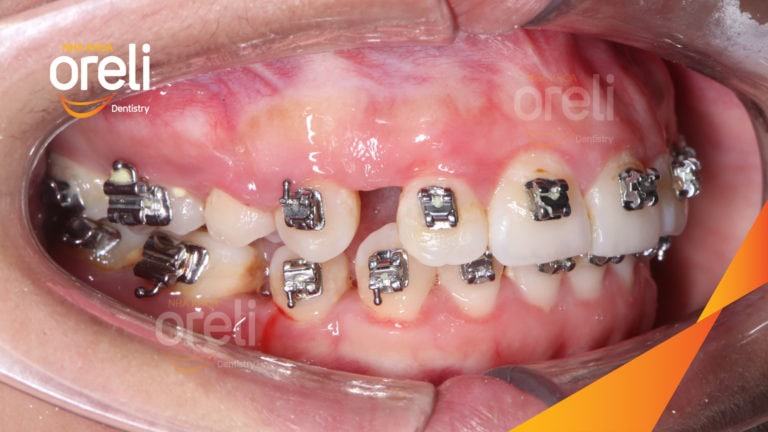 Ca niềng lại chỉnh cắn sâu hô hai hàm