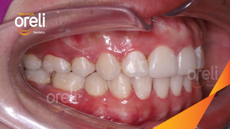 Ca niềng lại chỉnh cắn sâu hô hai hàm