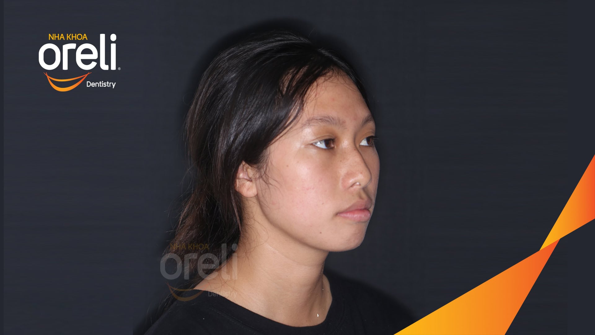 nieng rang chinh ho can sau uy tin nha khoa oreli