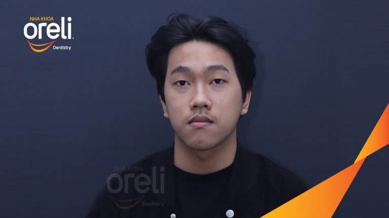 Niềng chỉnh lệch cằm sang phải