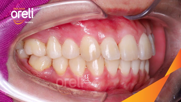 nieng rang chen chuc uy tin oreli nha khoa daklak