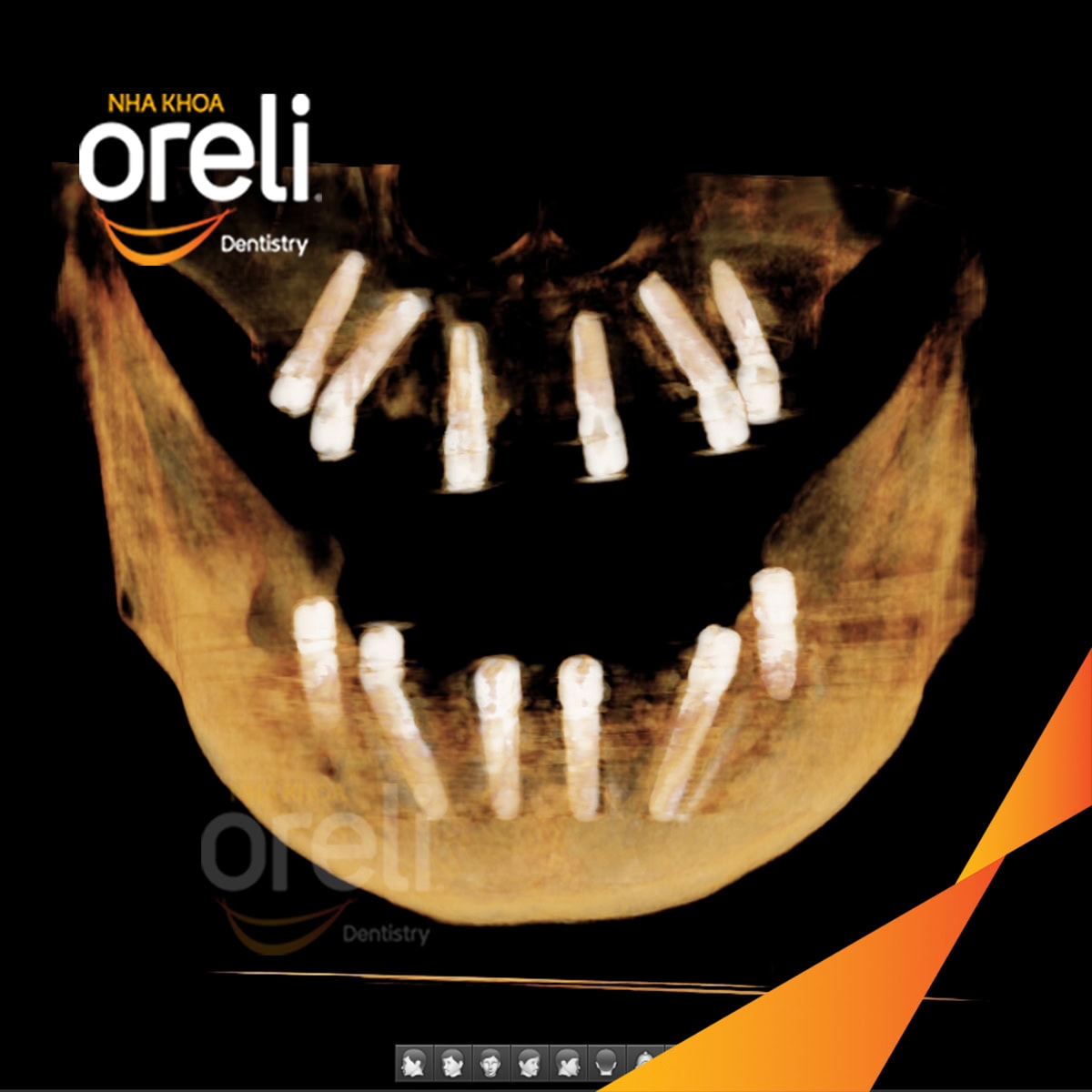 cay ghep implant toan ham chan buom nha khoa oreli