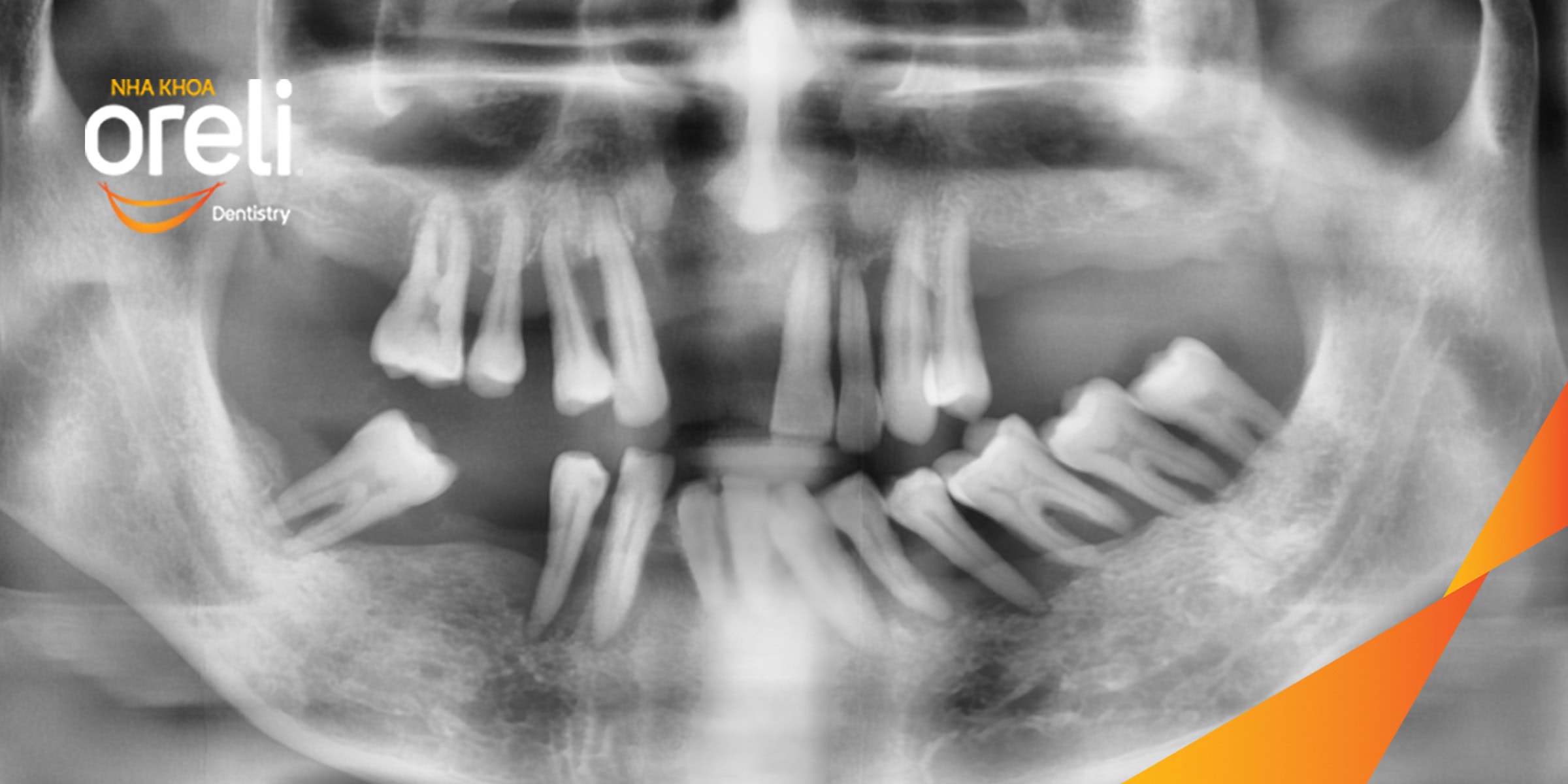 cay ghep implant toan ham chan buom nha khoa oreli