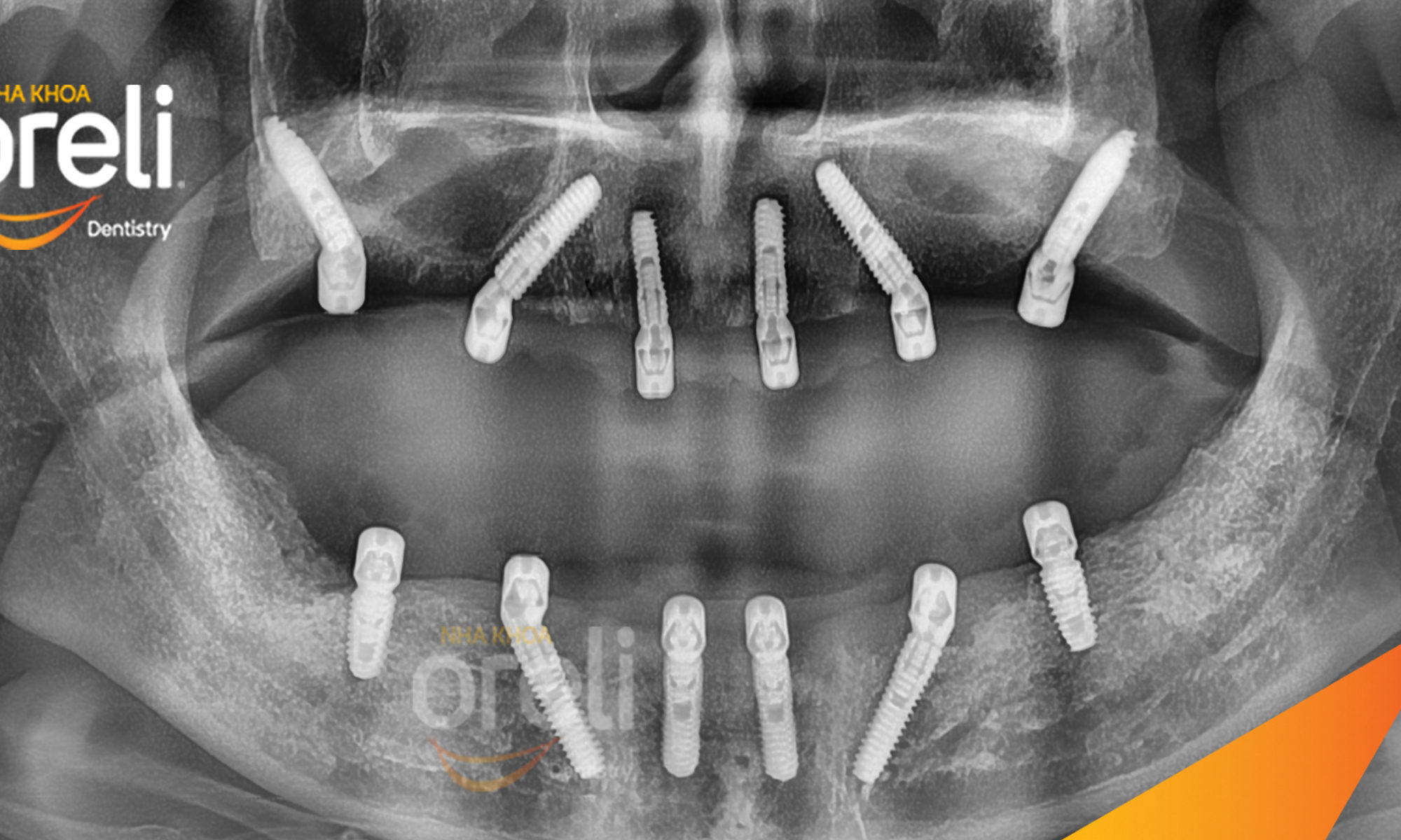 cay ghep implant toan ham chan buom nha khoa oreli