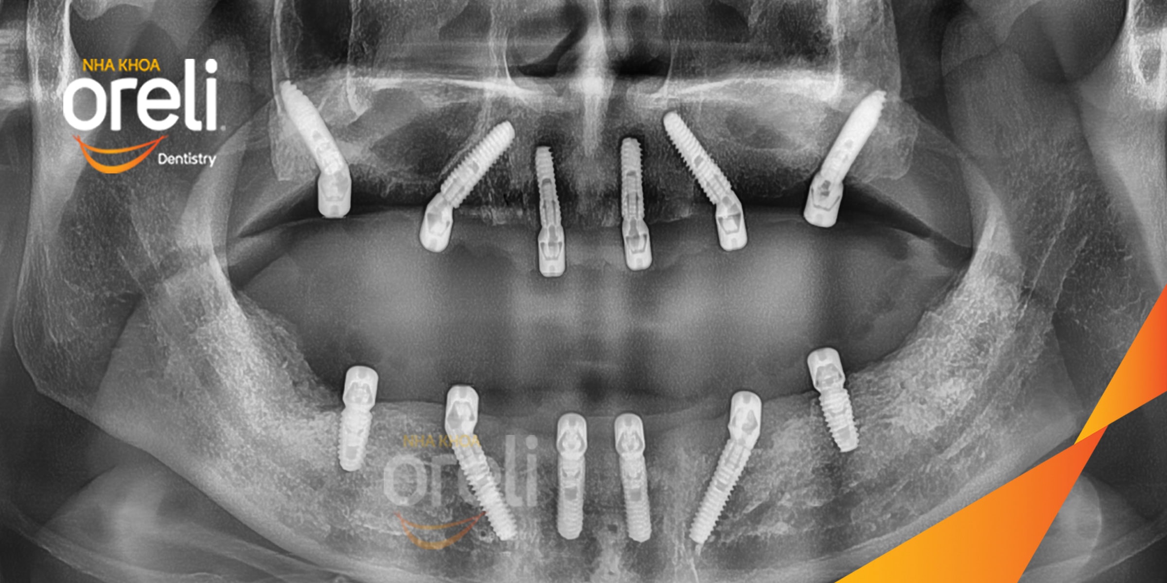 cay ghep implant toan ham chan buom nha khoa oreli