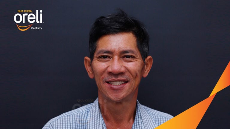 Tiêu xương hàm do mất răng lâu năm – Cách phục hồi hiệu quả bằng trồng răng Implant tại Oreli