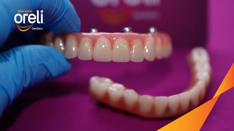 Tiêu xương hàm do mất răng lâu năm – Cách phục hồi hiệu quả bằng trồng răng Implant tại Oreli