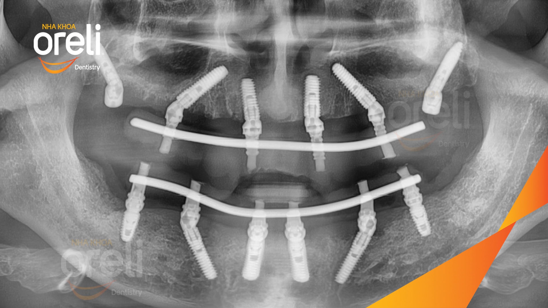 cay ghep implant toan ham chan buom nha khoa oreli