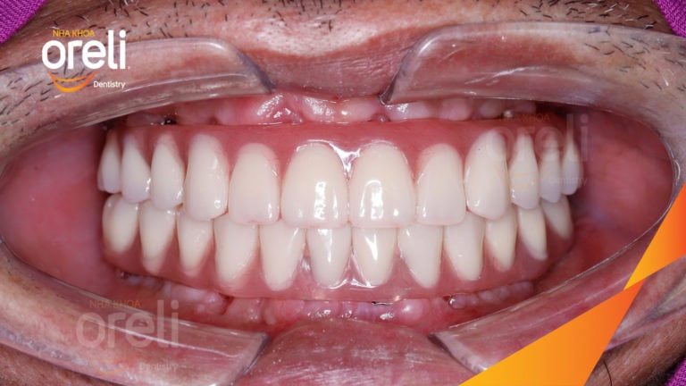 Tiêu xương hàm do mất răng lâu năm – Cách phục hồi hiệu quả bằng trồng răng Implant tại Oreli