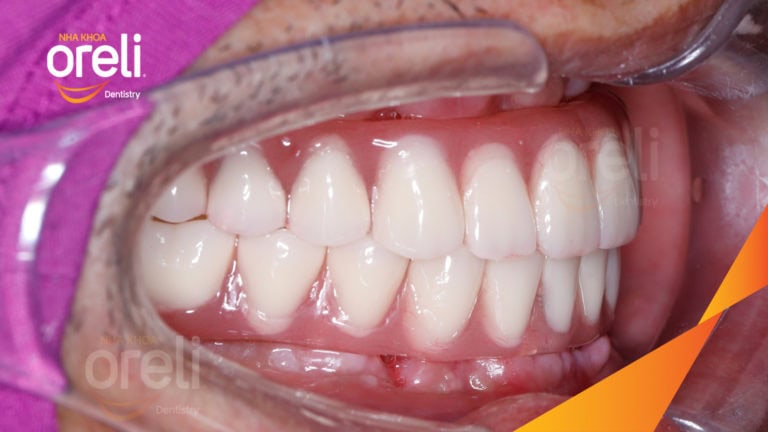 Tiêu xương hàm do mất răng lâu năm – Cách phục hồi hiệu quả bằng trồng răng Implant tại Oreli